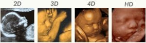Examples of 2D, 3D, 4D and HD ultrasounds